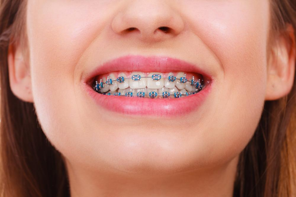 All About Metal Braces