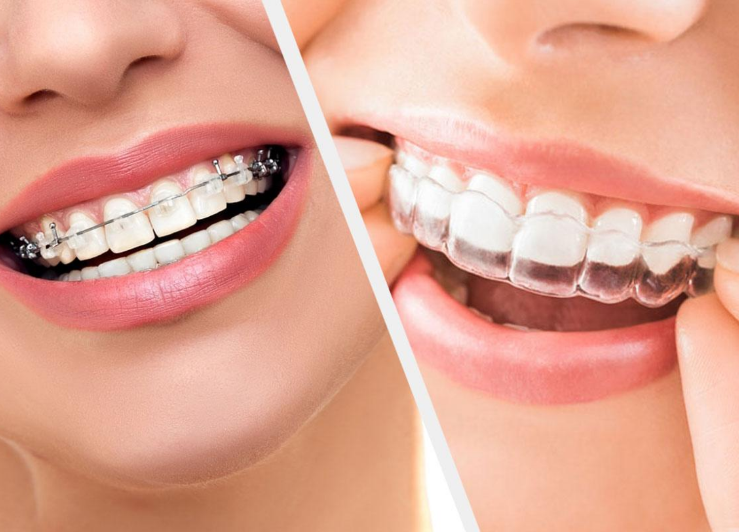 Why Orthodontic Treatment Is Important Orthodontist Whitby Braces Whitby Invisalign Whitby 