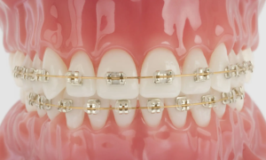 Esthetic-White-Gold-Braces