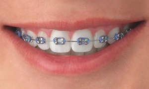 Traditional-Metal-Braces-img